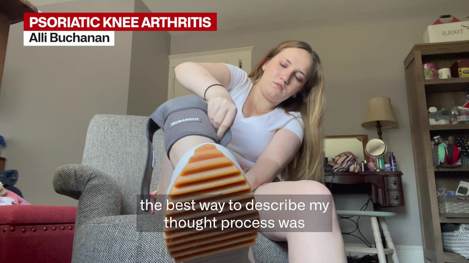 Alli Buchanan (Dancer) - Psoriatic Knee Arthritis